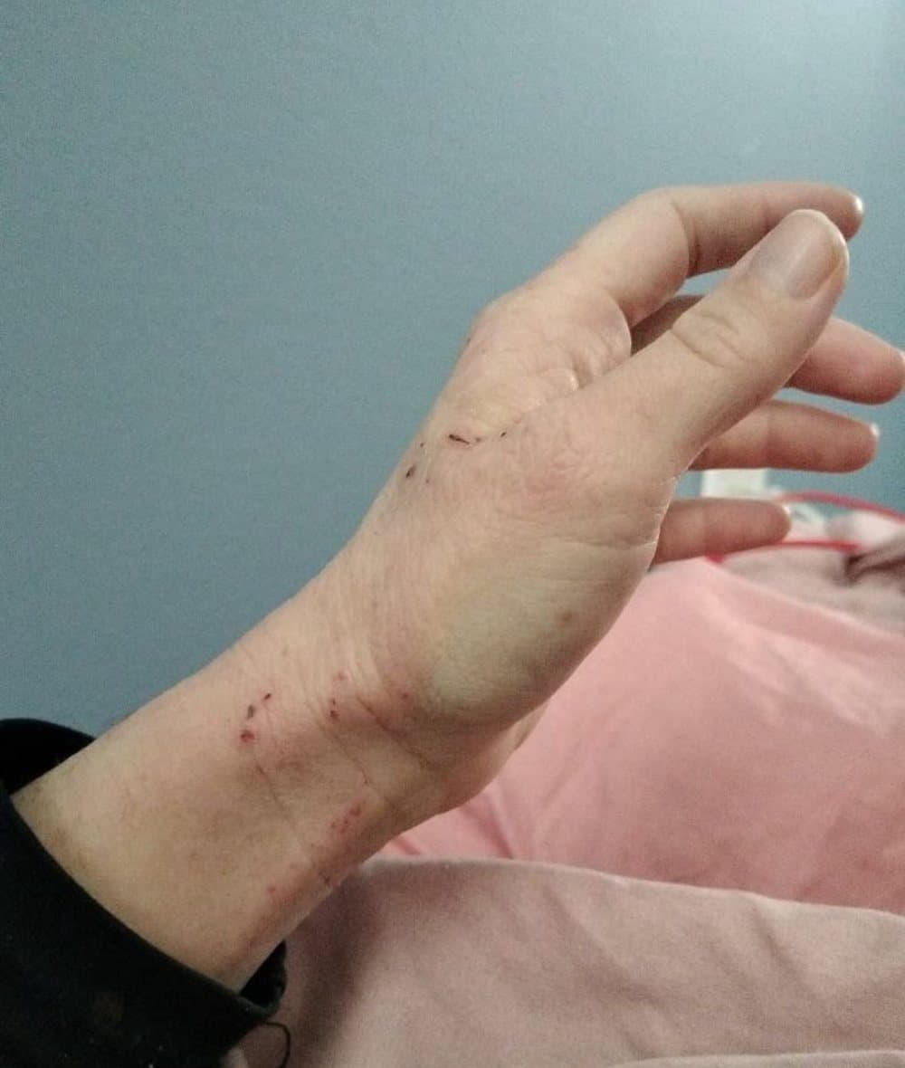 The same forearm and hand, skin largely clear