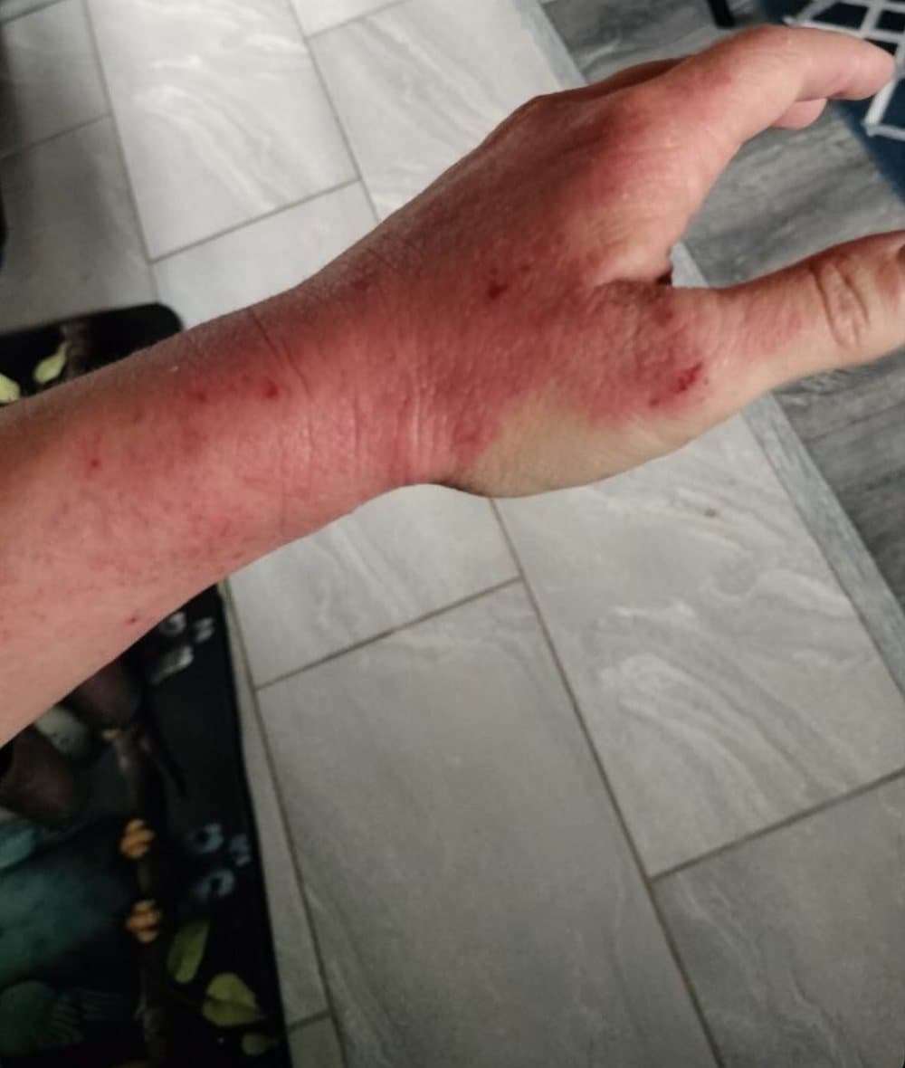 Forearm and hand with widespread inflamed eczema